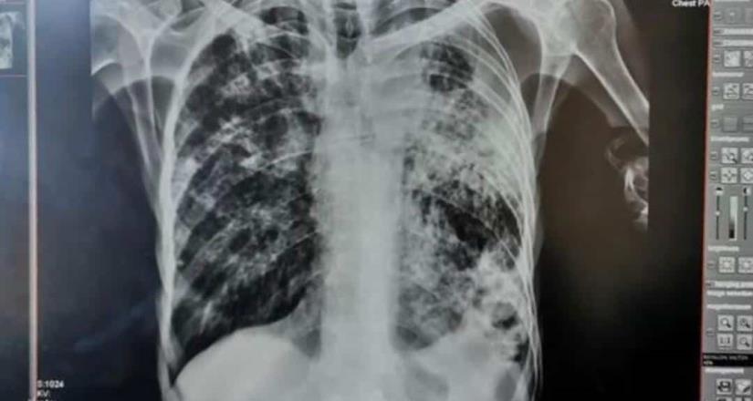 Importante detectar la tuberculosis a tiempo: Secretaría de Salud